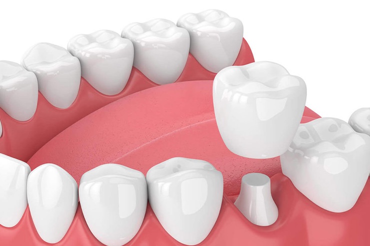 Dental Crowns & Bridge