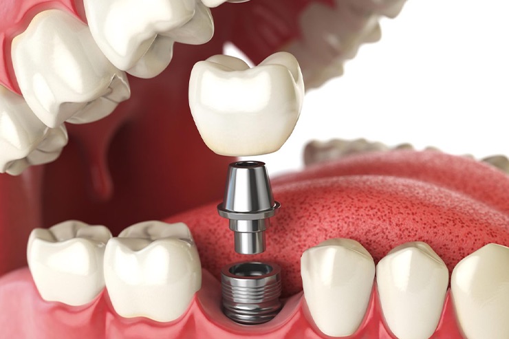 Dental Implants