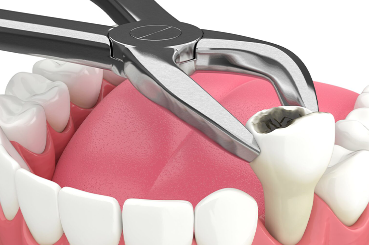 Tooth Extraction